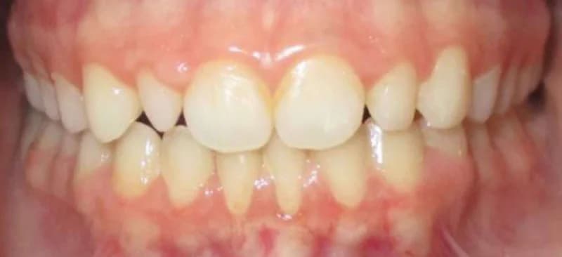 Patient's smile before cosmetic work by Dr. Arora.