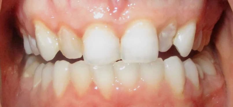 Patient's smile before cosmetic work by Dr. Arora.
